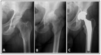 A-quadril normal B-quadril com artrose C- quadril com Protese